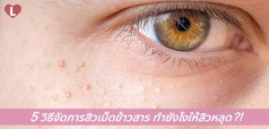 5 วิธีจัดการสิวเม็ดข้าวสาร ทำยังไงให้สิวหลุด?!