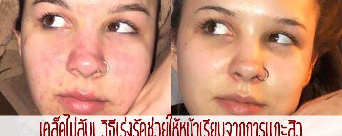 เคล็ดไม่ลับ! วิธีเร่งรัดช่วยให้หน้าเรียบจากการแกะสิว