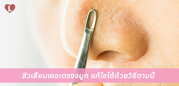 ลอกสิวเสียนเยอะตรงจมูก 7-11