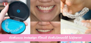 จัดฟันแบบ invisalign ที่ไหนดี จัดฟันใสถอดได้ ไม่ยุ่งยาก!