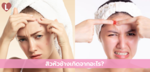 สิวหัวช้างเกิดจากอะไร?